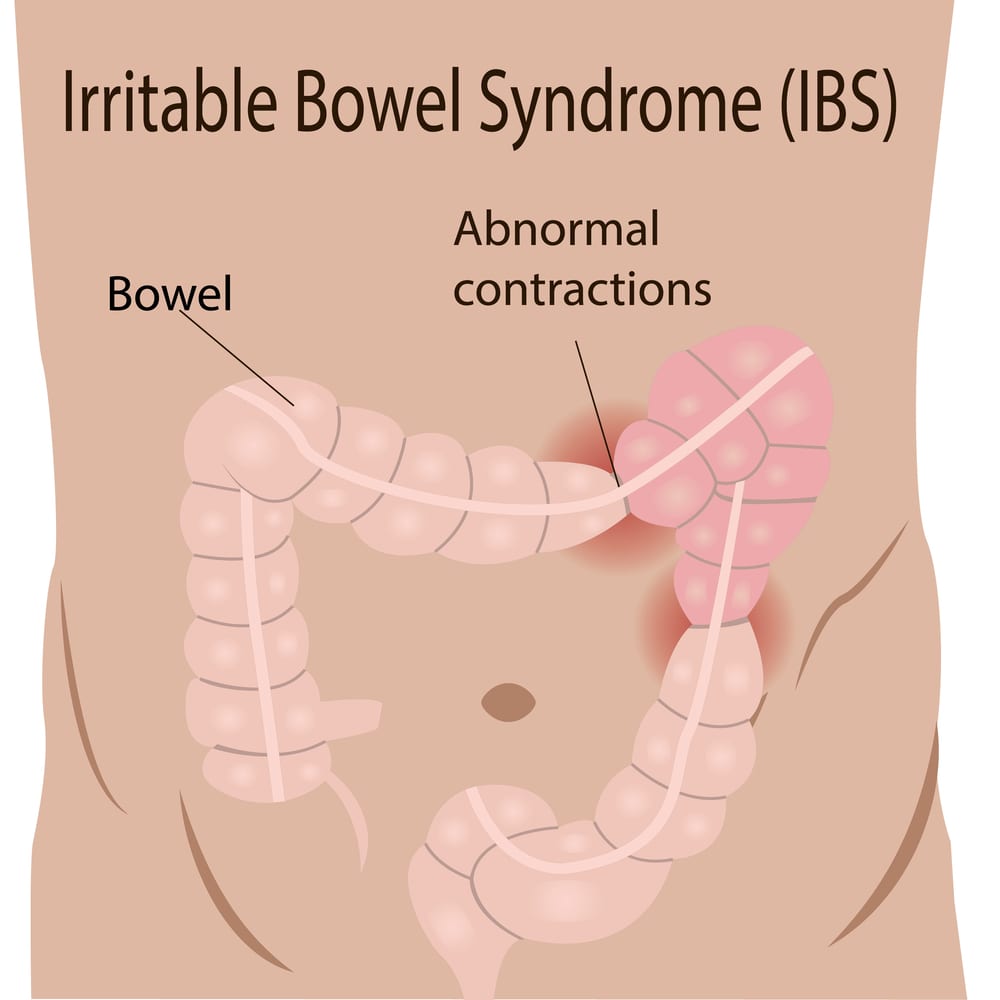 IBS